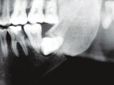 Figura 3B - Exposição do dente no trans-cirúrgico. A fratura da mandíbula está entre as piores complicações que podem ocorrer durante a exodontia de dentes inferiores.