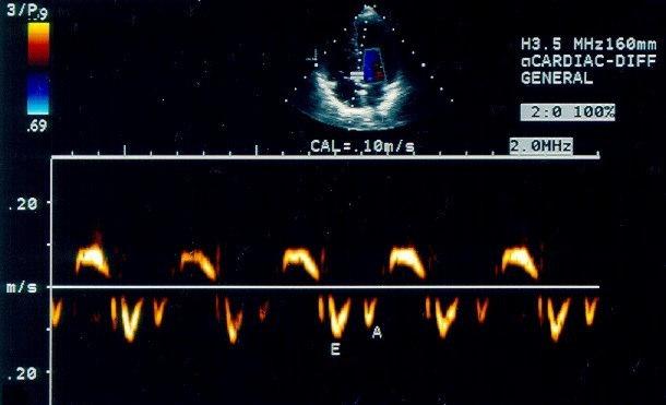 18 S S : velocidade de deslocamento miocárdico sistólico do VE; E : velocidade de deslocamento diastólico precoce