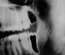Ao exame clínico, nenhuma alteração do periodonto foi constatada. O 48 estava semi-incluso, sendo visualizada parte da sua coroa.