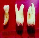Nas figuras 5 e 6 podem ser observados os dentes 18 e 28 extraídos e sendo mensurados.