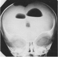 26 Hidrocefalia Capítulo 02 O presente capítulo aborda a hidrocefalia, uma condição patológica causada pelo acúmulo de líquido cefalorraquidiano nas cavidades intracranianas.