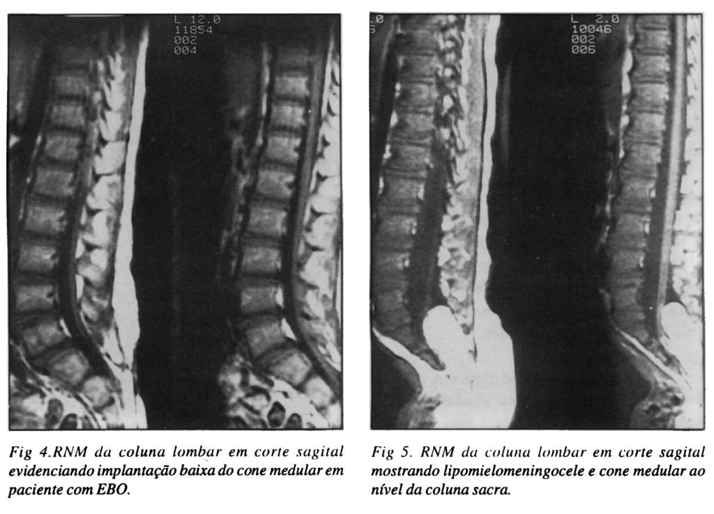 Nos 11 pacientes em que se estudou a transição occipitocervical, malformação de Chiari foi encontrada em 8, um deles apenas sendo sintomático.