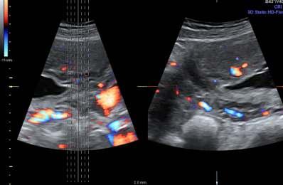 6 Papel da Ultrassonografia PAPEL DA ULTRASSONOGRAFIA NO DIAGNÓSTICO DA PLACENTA ANORMALMENTE INVASIVA (ACRETISMO PLACENTÁRIO) O valor da avaliação ultrassonográ ca d a p l a c e n t a é m u i t a s