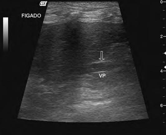 41 FIGURA 1. Imagem ultra-sonográfica em modo B da veia porta principal na região da porta hepatis.