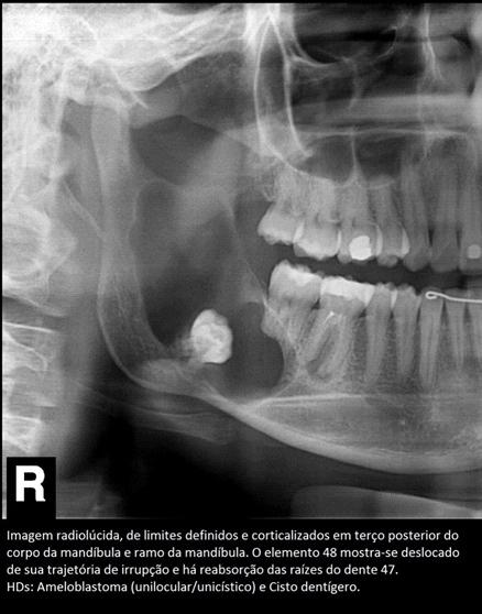 Boletim Inform ativo - setem bro 2016 Portanto, os tumores benígnos líticos, de aspecto radiolúcido/hipodenso, podem ter indicativos de seu comportamento biológico.