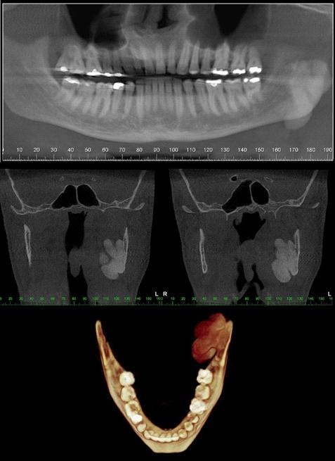 Boletim Inform ativo - setem bro 2016 O osteoma, outro tumor benigno que pode acometer a região maxilo mandibular, por outro lado, possui aspecto imaginológico radiopaco/hiperdenso.