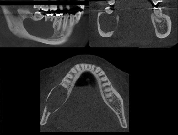 adelgaçamento das corticais vestibular e lingual do processo alveolar da mandíbula (lado