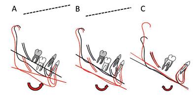 274 Figura 4 (A-C) A) Rotação verdadeira da mandíbula analisada por um plano construído sobre implantes metálicos ou estruturas estáveis da mandíbula relativo a base do crânio; B) Rotação aparente da