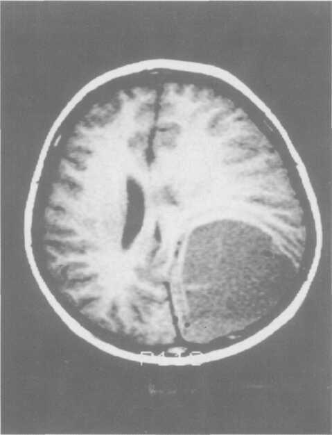 Durante a internação, paciente evoluiu com convulsões tônico-clônicas generalizadas, anisocoria e rebaixamento do nível de consciência, sugerindo quadro de herniação cerebral.
