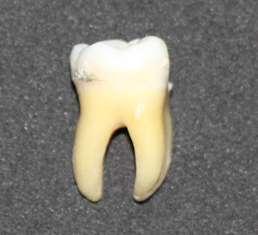 14 A Figura 1. A) Análise macroscópica do dente; B) Análise radiográfica do dente. B 3.