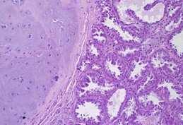 Os tumores mistos benignos são caracterizados pela proliferação benigna de células morfologicamente semelhantes a componentes epiteliais (luminais ou mioepiteliais) e células mesenquimais que
