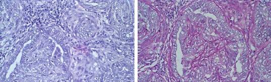 A presença de medula óssea com tecido hematopoético e tecido adiposo de permeio pode ser observada em alguns casos (Figura 1). Figura 1: Tumor misto benigno.