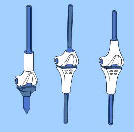 3- ENDOPRÓTESE NÃO CONVENCIONAL R.J.G. BIAXIAL DE JOELHO A prótese utilizada por nós desenvolvida é composta de dois eixos de movimento e devido a isso foi batizada como bi-axial.