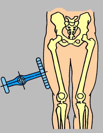 Para se prescrever e solicitar uma endoprótese não convencional, utilizamos radiografias, em incidência ântero-posterior e lateral, de todo o osso a ser operado e frequentemente do osso