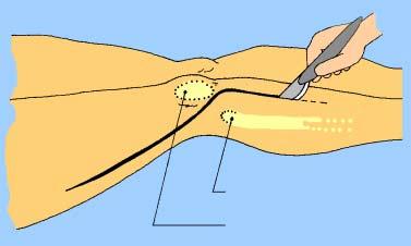 JOELHO - FÊMUR DISTAL E TÍBIA PROXIMAL 1. TÉCNICA PARA A ABORDAGEM DA EXTREMIDADE DISTAL DO FÊMUR É realizada com o paciente em posição supina.