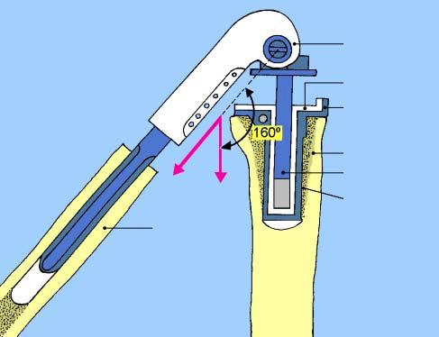 A redução da prótese é feita, através de uma flexão de 160 graus da perna sobre a coxa e os dois componentes são encaixados concomitantemente.