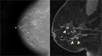 Patologias Mamárias Método complementar à mamografia e à ecografia