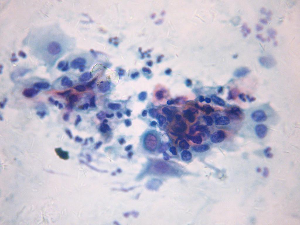 25 Figura 1 - Células escamosas atípicas dispostas em grupamentos, destacando-se núcleos fusiformes, hipercromáticos e cromatina ora granular ora densa: compatível