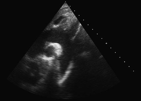 Janela supra-esternal Visualização da aorta descendente 47 Tipicamente, os vasos supra-aórticos deslocam-se para cima e