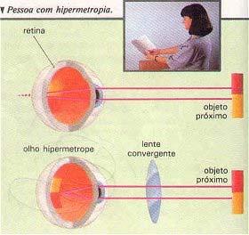 Astigmatismo: a imagem de um ponto não é um ponto sobre a retina. Fenômeno devido a diferenças de curvatura da córnea.