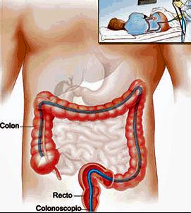 COLONOSCOPIA (Endoscopia digestiva baixa antes das 16:00) A Colonoscopia é um exame que permite observar o intestino grosso, desde o ânus até à passagem entre o intestino grosso e o delgado, através