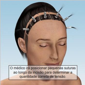 Aumento do músculo Em geral, existem três músculos diferentes na face superior que podem ser acessados, incluindo o músculo frontal, corrugador e prócero.