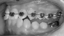 O arco mandibular pode permanecer sem aparelho por vários meses enquanto os dentes posteriores