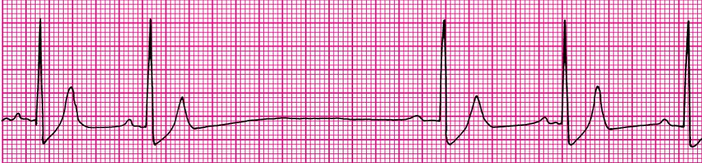 Paragens sinusais Depressão do automatismo do NSA (formação do estímulo) Ausência de ondas P Onda P: periodicamente ausente (P-QRS-T ausentes) não são múltiplos de 2