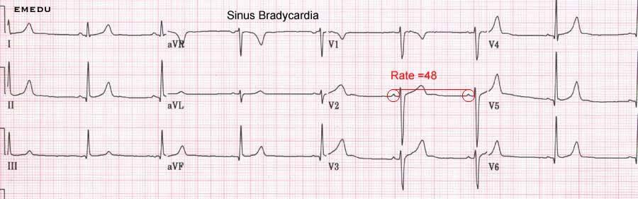 Bradicardia sinusal Origem no NSA, com FC < 60/min Ondas P de morfologia normal,