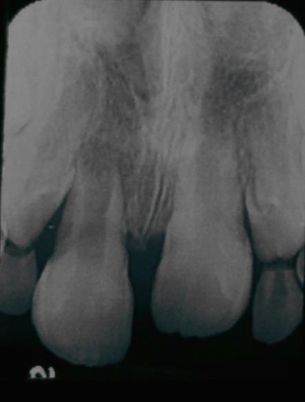 Dentes necrosados com ápice aberto tradicionalmente recebem um tratamento denominado de apicificação.