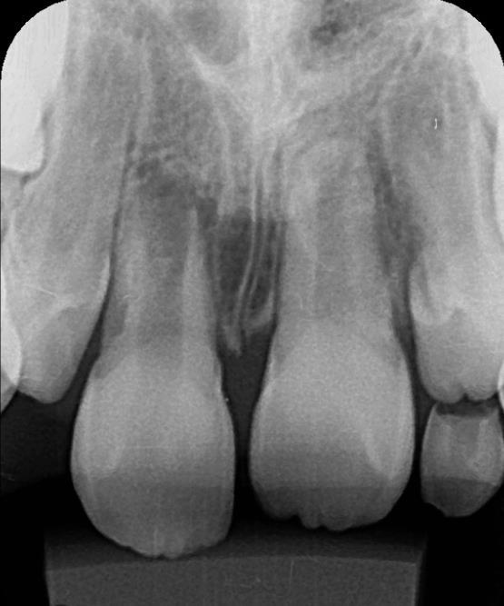 Porém, sua desvantagem está na necessidade de um tempo relativamente longo (9-24 meses) e apesar de proporcionar um fechamento apical, e por vezes o desenvolvimento radicular apical, não permite o