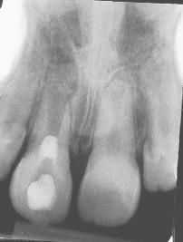 colágeno (hemospon) sobre o coágulo para mantê-lo em posição, e colocado uma barreira cervical com cimento reparador Agregado de Trióxido Mineral (MTA), e na sequência realizou-se o selamento