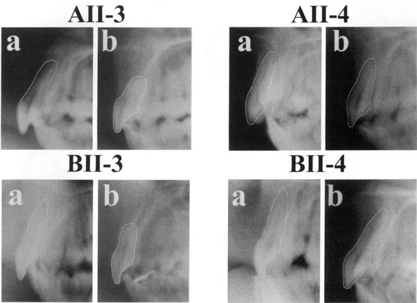 CONSOLARO, A; MARTINS-ORTIZ, M. F. molar inferior. McFadden et al. (Referência do texto original de Al-Qawasmi et al.