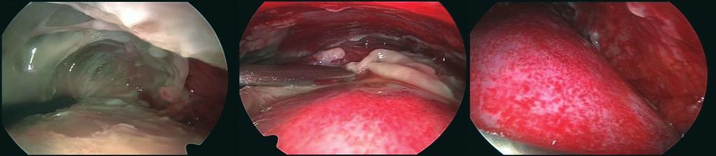 Toracoscopia no tratamento do empiema pleural em pacientes pediátricos 209 particularmente pelo pediatra; e 3) pode-se insuflar a cavidade pleural com dióxido de carbono para se criar um pneumotórax