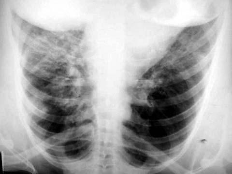 Proteinose alveolar pulmonar: relato de caso Arquivos Catarinenses de Medicina Vol. 35, n o.