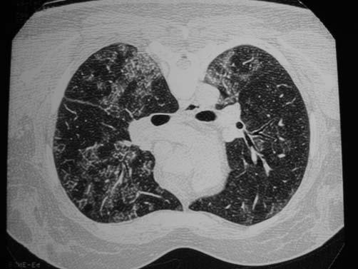 Figura 4 - Biópsia parênquima pulmonar.
