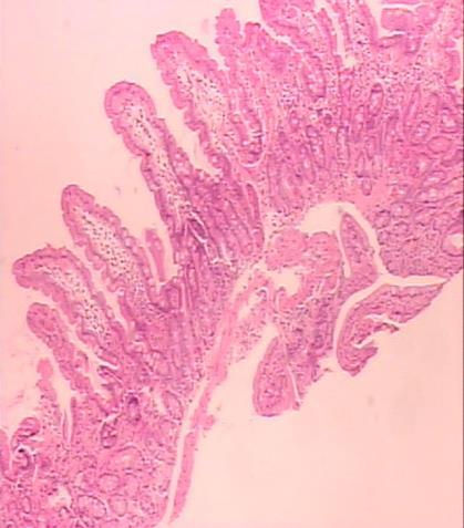 e) Resposta correta: a Comentário: A resposta a) representa uma biopsia de intestino delgado com atrofia vilositária que confirma a hipótese diagnóstica de doença celíaca.