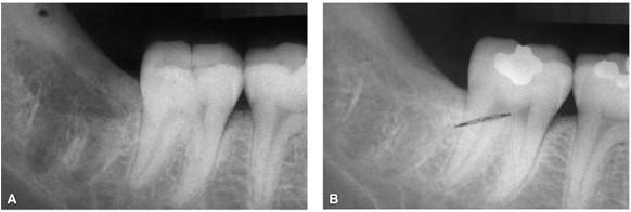 Reparo de fratura óssea Ossificação intramembranosa Reparo alveolar após extração dentária