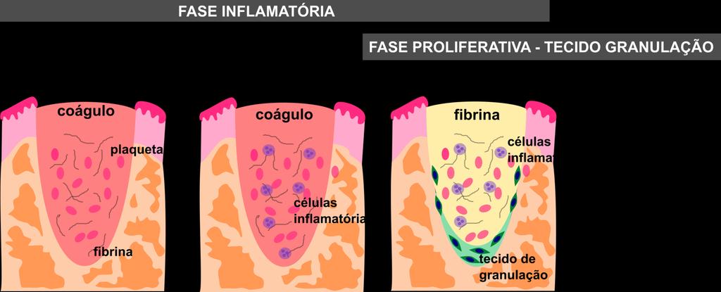 Reparo de fratura óssea Ossificação intramembranosa Reparo do