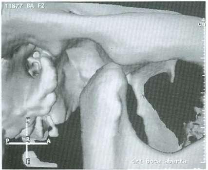 b) Disco articular: Entre estas duas cartilagens existe um fino