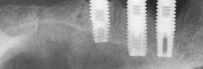 Aspecto radiográfico de indivíduo portador de peri-implantite apresentando extensa perda óssea radiográfica: a) implante localizado na região de maxila posterior e b) implante localizado na porção