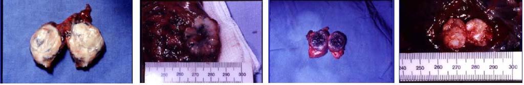 23 2. Fundamentação teórica Neste capítulo é dada uma descrição sucinta do nódulo pulmonar, a forma de aquisição das imagens em tomografia computadorizada, o método responsável pela sua segmentação,