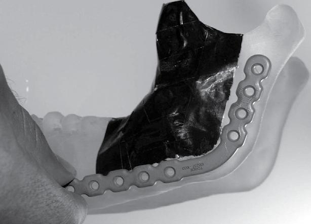 Reconstrução da mandíbula: observar fixação da placa do sistema 2,7 mm na região de sínfise à região de côndilo da mandíbula com parafusos bicorticais. Figura 6.