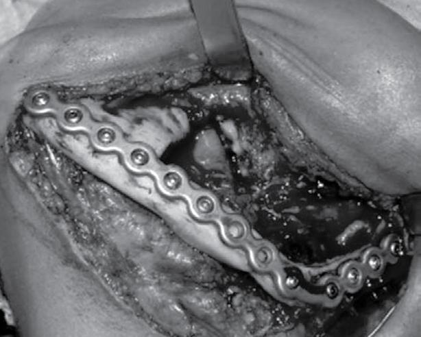 Incisão em região submandibular, dissecção da musculatura inserida na mandíbula e osteotomia com remoção de 1,0 a 2,0 cm de osso sadio, através do uso de broca,