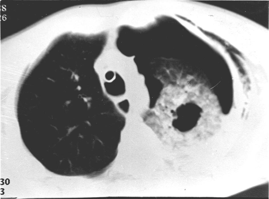 LESÕES TRAUMÁTICAS DO TÓRAX. ASPECTOS NA TOMOGRAFIA COMPUTADORIZADA/ Fig. 3 Corte com janela para parênquima pulmonar evidenciando pneumotórax à esquerda, com enfisema de partes moles.