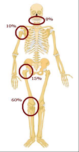 Fibrodisplasia Ossificante Progressiva: O início dos sintomas na primeira década de vida e a ossificação progressiva de partes moles evidenciada no estudo radiográfico desta doença a torna não