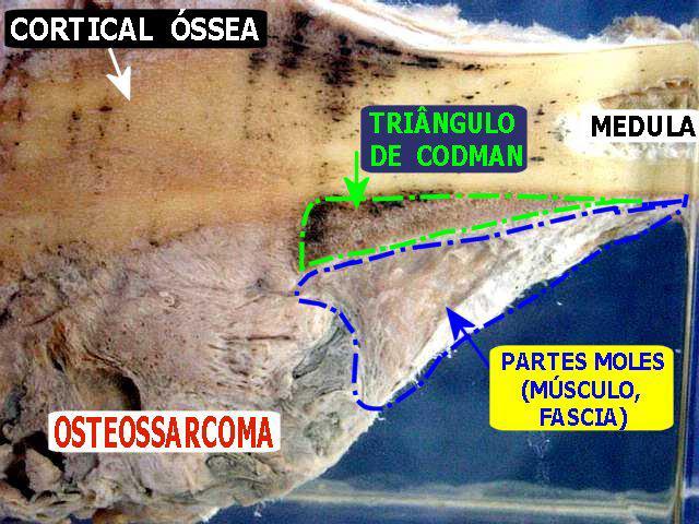 Alguns tipos de tumores ósseos caracterizam-se por produzir osso neoplásico (osteoescleróticos), enquanto outros se manifestam predominantemente por destruição óssea (osteolíticos).