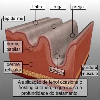 Efeitos de um procedimento de peeling profundo Muito semelhante ao peeling médio, a aplicação de fenol ocasiona o que é conhecido como frosting cutâneo [aspecto esbranquiçado que indica desnaturação