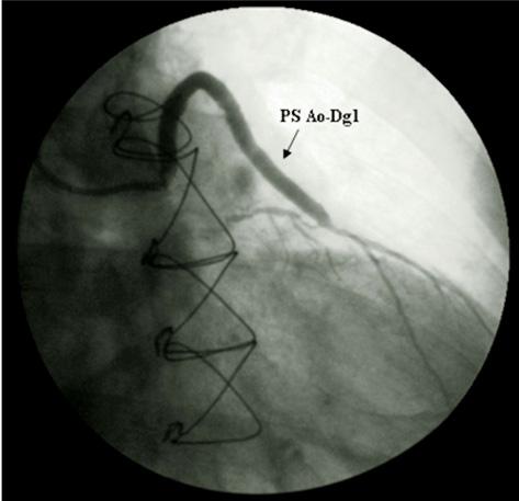 A B C Figura 2 - Em A, angiografia no enxerto ponte de safena aorta-primeira diagonal (PS Ao-Dg1), evidenciando grande carga de trombo na anastomose distal (T).