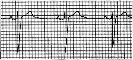 QRS AVALIAÇÃO do ECG P T U P R QT QR S 0,12s < PR < 0,20s H